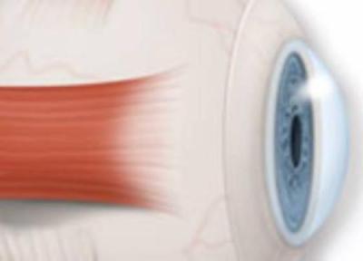 13 باور اشتباه درباره چشم 13 باور اشتباه درباره چشم